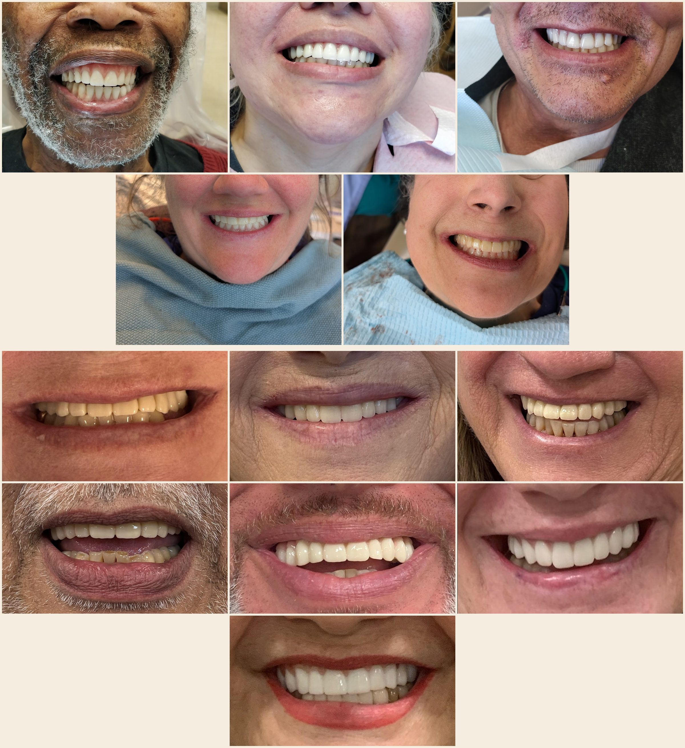 Real All-on-4 patient before and after results — dental implant transformations at BaySmile Implant Center Bay Area